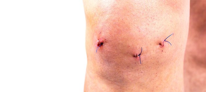 Knee-Arthroscopy