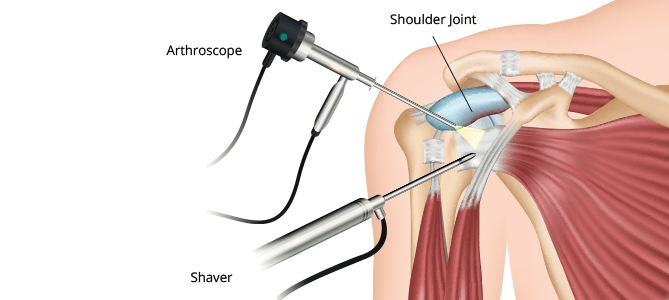 shoulder surgery