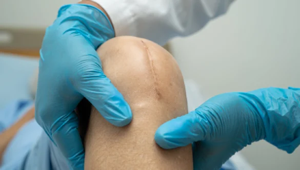How Knee Joint Replacement Surgery Improves Quality of Life